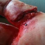 CPT Expert Witness Services- Dog Bite Injury