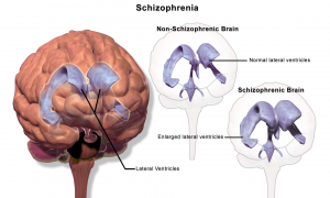 Schizophrenia Brain Structure